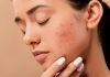 Fungal Acne