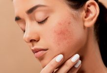 Fungal Acne