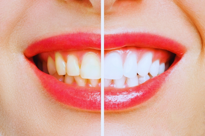 Investing in Whitening for a Radiant Smile